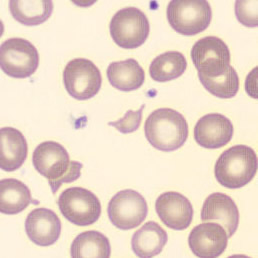 Peripheral blood-smear image for morphology question 3