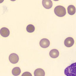 Peripheral blood-smear image for morphology question 1