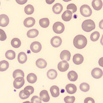 Peripheral blood-smear image for morphology question 2