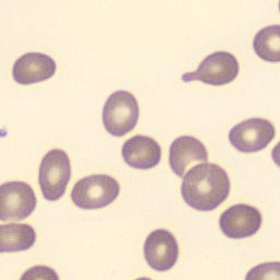 Peripheral blood-smear image for morphology question 4